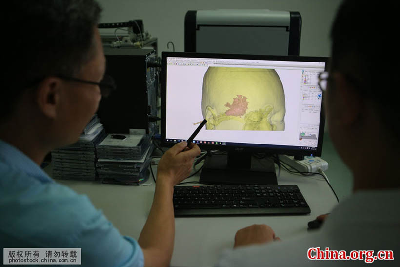Cirurgia cerebral com tecnologia de impress?o 3D é realizada em Shandong