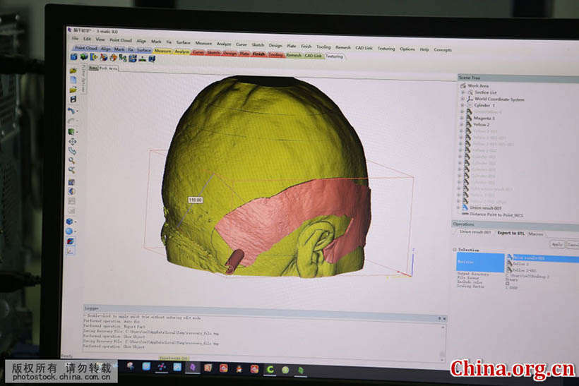 Cirurgia cerebral com tecnologia de impress?o 3D é realizada em Shandong