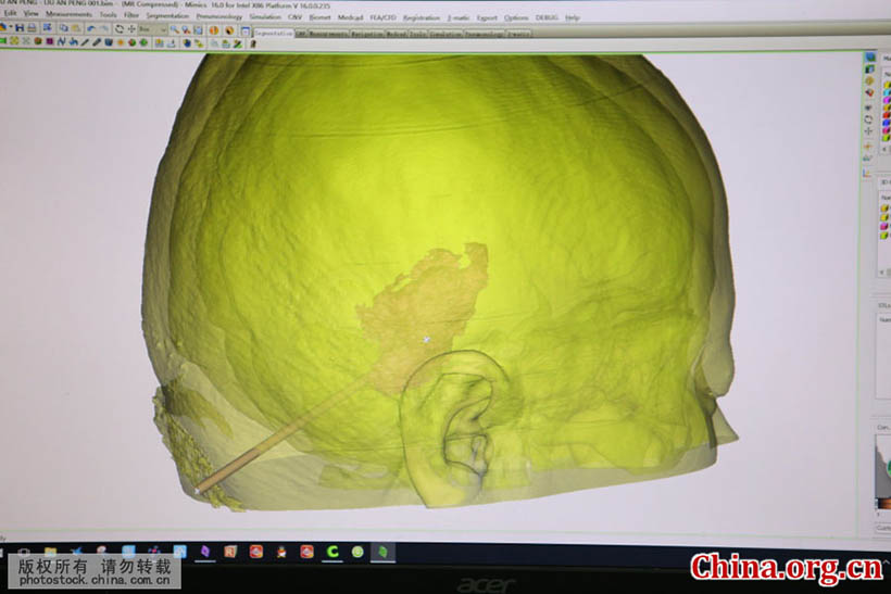 Cirurgia cerebral com tecnologia de impress?o 3D é realizada em Shandong