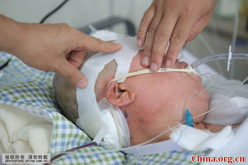 Cirurgia cerebral com tecnologia de impress?o 3D é realizada em Shandong