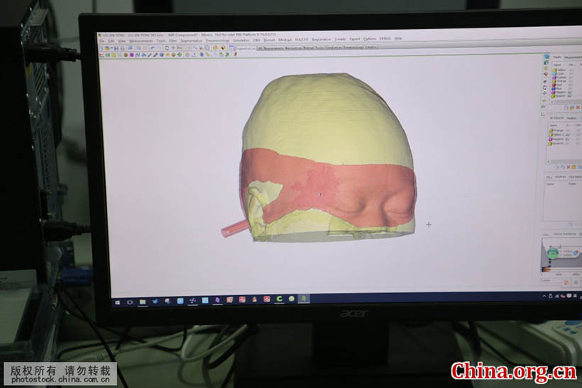 Cirurgia cerebral com tecnologia de impress?o 3D é realizada em Shandong