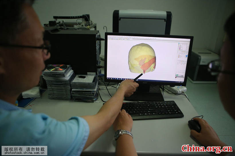 Cirurgia cerebral com tecnologia de impress?o 3D é realizada em Shandong